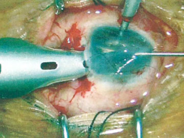 角膜皮内移植手術を施工した症例01